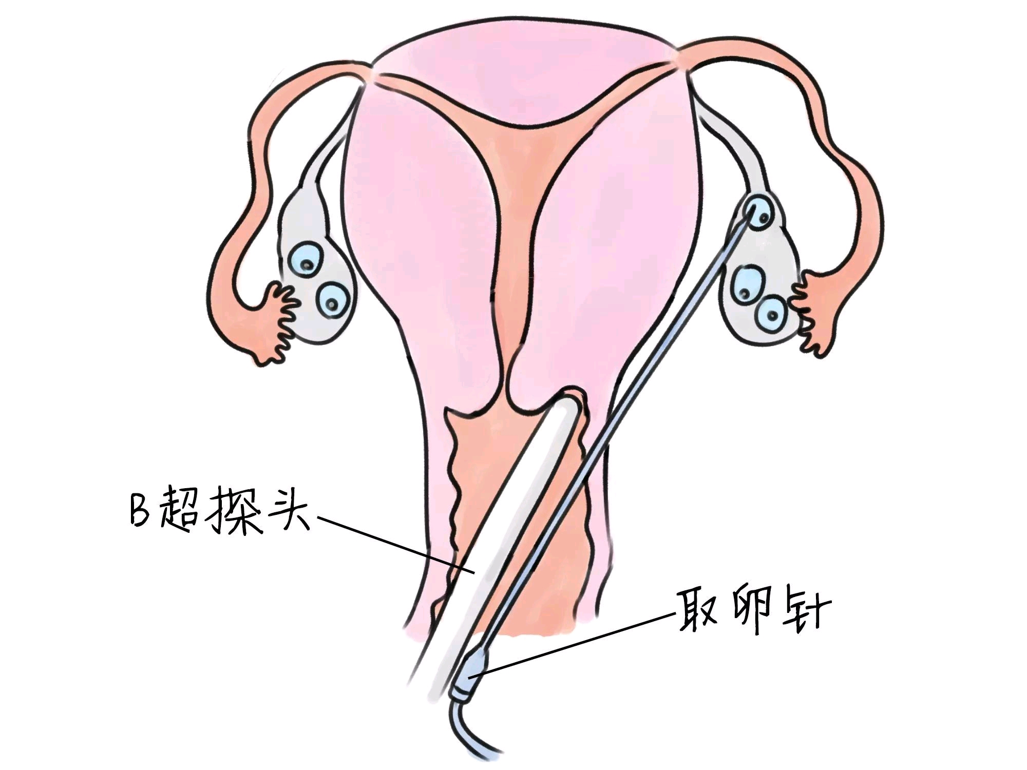 洛阳试管婴儿
