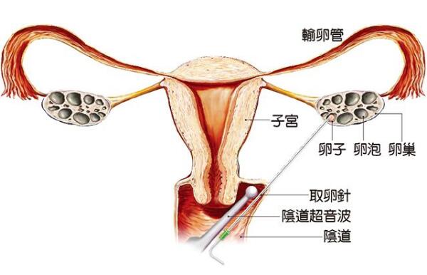 泰国试管婴儿